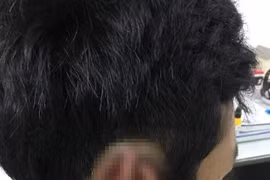 Hy hữu: Nối lại tai cho nam sinh bị bạn cắn đứt rồi nuốt vào bụng