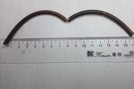 Kinh hãi dị vật nằm suốt 20 năm trong tá tràng