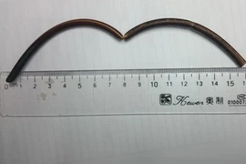 Kinh hãi dị vật nằm suốt 20 năm trong tá tràng