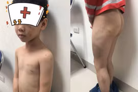 Hà Nội: Nghi vấn bố đánh con đẻ 7 tuổi bầm tím