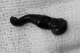 Gắp con đỉa chui trong hốc mũi cháu bé người Mông