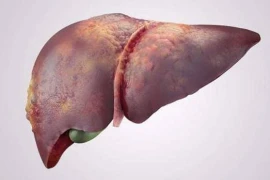 2 nguyên nhân khiến người gầy bị gan nhiễm mỡ