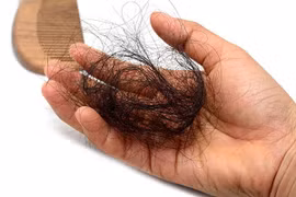 Vì sao người trẻ tuổi lại bị rụng tóc nhiều?