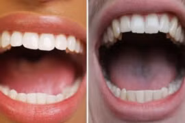 Làm thế nào để ngăn ngừa ung thư miệng trong cuộc sống hàng ngày