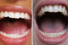 Làm thế nào để ngăn ngừa ung thư miệng trong cuộc sống hàng ngày