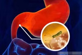 Cảnh giác với 5 dấu hiệu từ bệnh dạ dày đến ung thư 