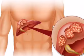 Dấu hiệu quan trọng cảnh báo gan đang 'kêu cứu'