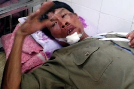 Bị kẻ trộm chó đâm gãy tay, mất răng cửa