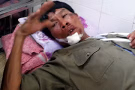 Bị kẻ trộm chó đâm gãy tay, mất răng cửa