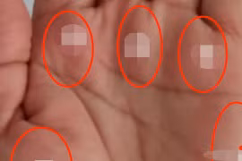 Lòng bàn tay có ba đỉnh sẽ mang lại phú quý