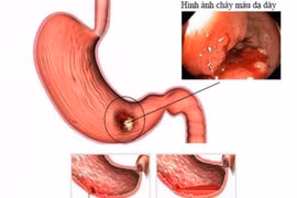 Sau một đêm không ngủ để làm điều này, vợ trẻ nôn ra máu phải cấp cứu