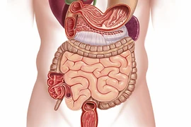 Các bệnh nào dễ dẫn đến ung thư đại tràng?