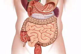 Các bệnh nào dễ dẫn đến ung thư đại tràng?