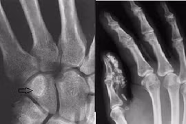 Bị bệnh u xương sụn có nguy hiểm không?