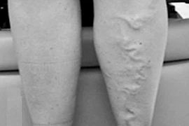 Nổi mạch máu màu xanh có nguy hiểm không? 