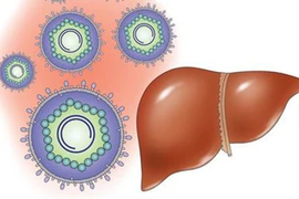 Ung thư biểu mô tế bào gan có biểu hiện gì?