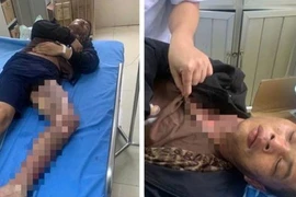 Trộm dây điện, hai người ở Bắc Kạn bị điện giật bỏng nặng 