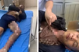 Trộm dây điện, hai người ở Bắc Kạn bị điện giật bỏng nặng 