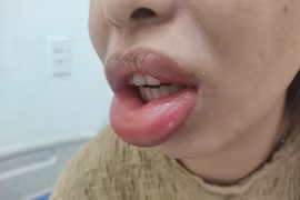 Tiêm môi, nâng ngực làm đẹp: Hậu quả khó lường khi tới các thẩm mỹ 'chui'