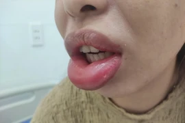 Tiêm môi, nâng ngực làm đẹp: Hậu quả khó lường khi tới các thẩm mỹ 'chui'