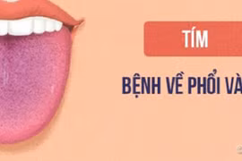 Bỏ qua dấu hiệu bất thường trên lưỡi, cẩn thận mắc bệnh hiểm