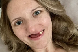 Nữ sinh rụng răng như bà lão, đau đớn sống không bằng chết