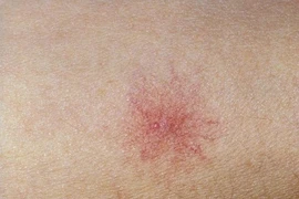 Có dấu hiệu này, đi khám ngay kẻo hại gan khó cứu vãn 