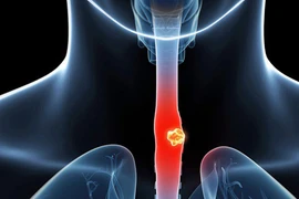 4 kiểu ăn phổ biến, sớm muộn gây ung thư thực quản