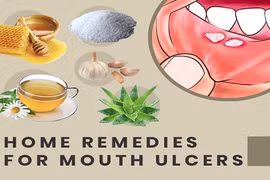Đánh bay loét miệng khó chịu bằng liệu pháp thiên nhiên