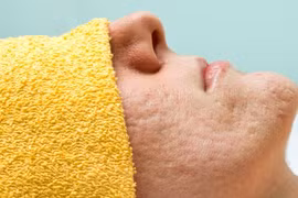 Những nguyên nhân không ngờ khiến bạn sở hữu lỗ chân lông to