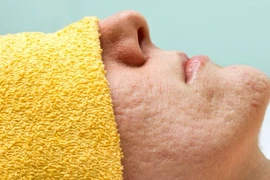 Những nguyên nhân không ngờ khiến bạn sở hữu lỗ chân lông to