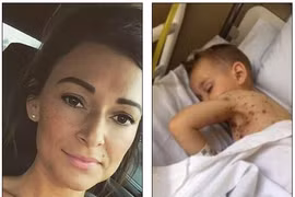 Biến chứng nhiễm trùng máu thủy đậu do dùng sai thuốc