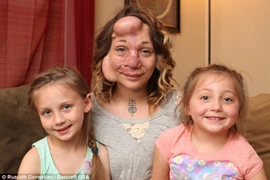 Kỳ lạ chèn bóng bay vào mặt để căng da chữa bệnh