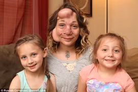 Kỳ lạ chèn bóng bay vào mặt để căng da chữa bệnh