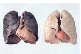 Tác động khủng khiếp của ô nhiễm không khí đến sức khỏe