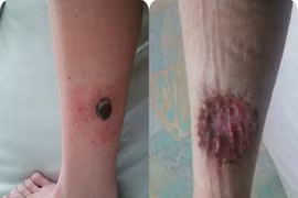 Suýt chết vì thói quen nằm giường tắm nắng