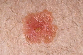 Cận cảnh cơ chế ung thư da từ ánh mặt trời