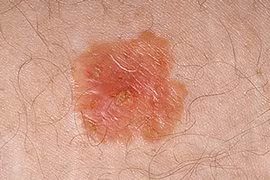 Cận cảnh cơ chế ung thư da từ ánh mặt trời