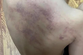 Kết quả giám định vụ bé 5 tuổi bị bầm tím lưng khi đi học