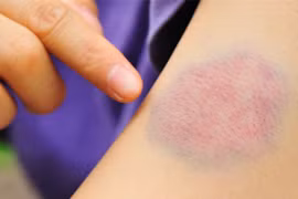 Cách làm tan vết bầm tím trên da vô cùng hiệu quả