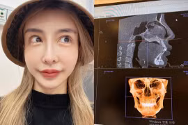 Sốc nặng ảnh chụp X-quang của người mẫu nghiện dao kéo