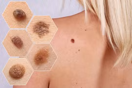 3 bộ phận trên người chuyển thâm đen, cảnh báo ung thư cần đi khám sớm