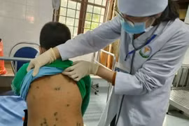 Hà Nội: Ghi nhận khoảng 800 ca mắc thủy đậu từ đầu năm