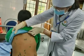 Hà Nội: Ghi nhận khoảng 800 ca mắc thủy đậu từ đầu năm