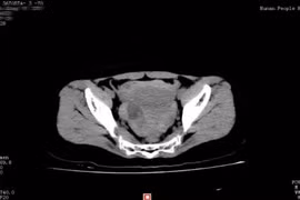 Suýt chết vì vỡ u nang buồng trứng khi 'yêu'