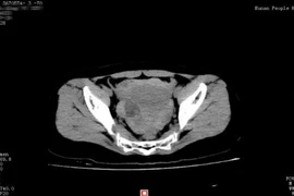 Suýt chết vì vỡ u nang buồng trứng khi 'yêu'