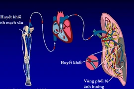 Thuyên tắc phổi suýt chết vì ôm máy tính hơn 12 giờ/ngày