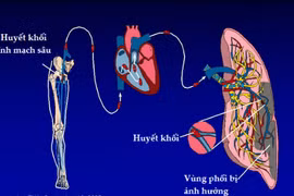 Thuyên tắc phổi suýt chết vì ôm máy tính hơn 12 giờ/ngày