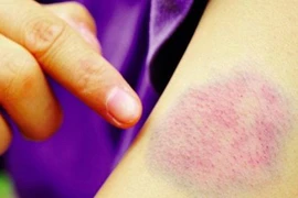  Thấy da thế này đi khám ngay kẻo tới lúc bán nhà cũng chẳng cứu được