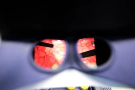 Vỡ bàng quang do ngã xe máy sau cuộc nhậu